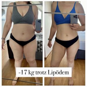 Wie Rebecca trotz Lipödem 17 kg abgenommen hat